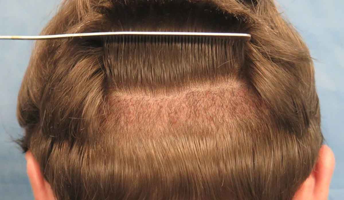 بعد زراعة الشعر , خطوات مابعد زراعه الشعر واعادة النمو