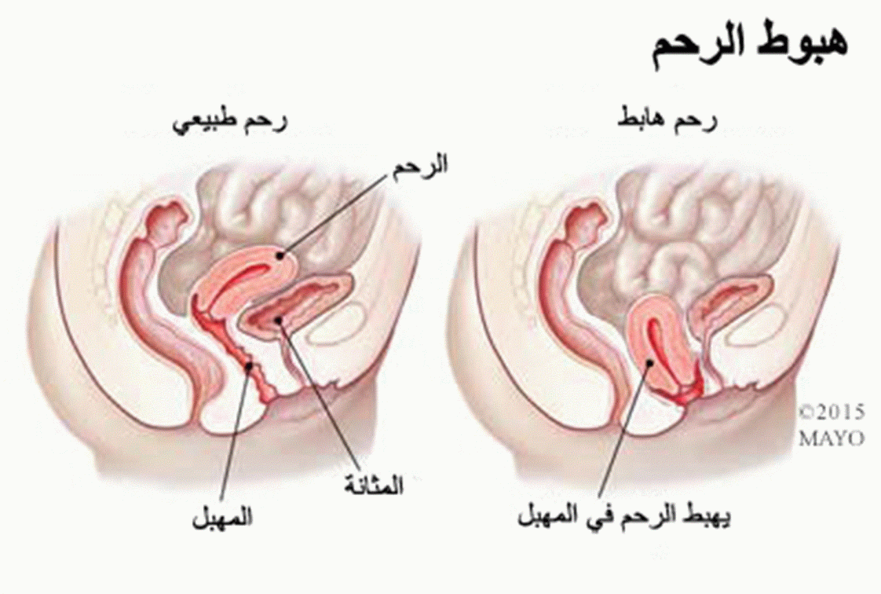 نزول الرحم بعد الولادة - حدوث نزول للرحم بعد الولاده وما مخاطره 1844 1