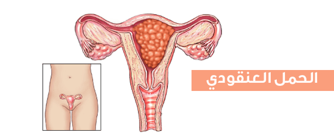 ماهو الحمل العنقودي - تعريف الحمل العنقودى 4094 1