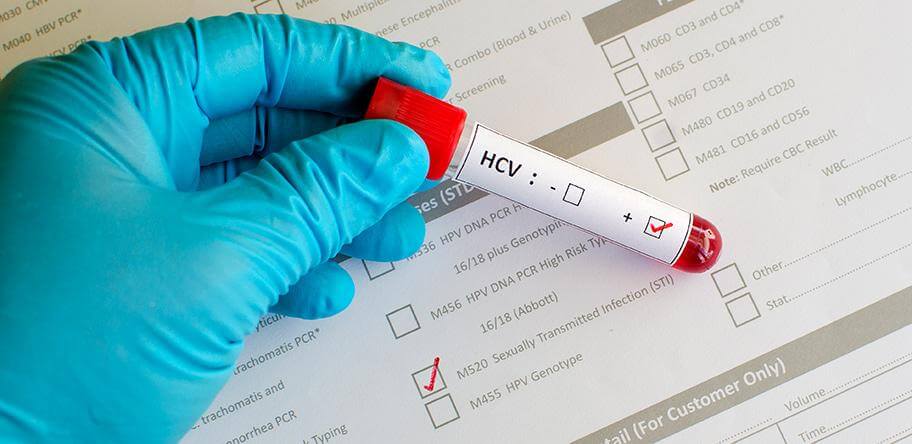 ما هو تحليل Hcv - تحليل يجب معرفته للحفاظ علي الجسم 2986 1