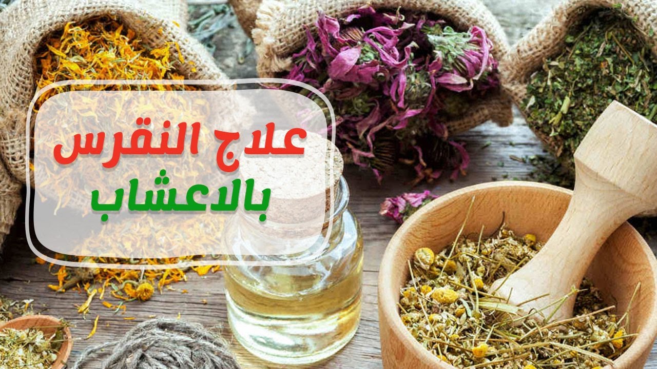 مرض النقرس وعلاجه بالاعشاب - علاج النقرس بالاعشاب 1641 1