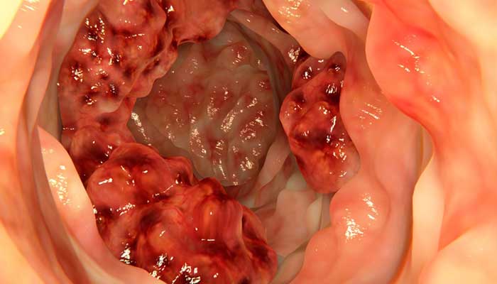 اعراض سرطان المستقيم , ازاي اعرف ان ممكن يكون عندي السرطان