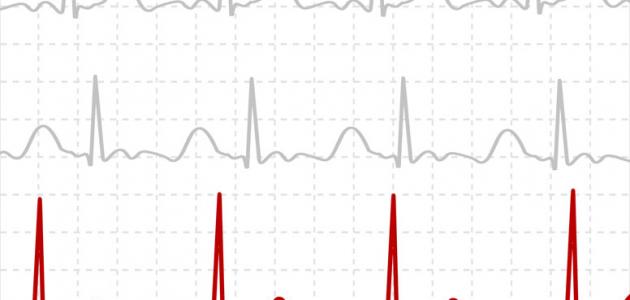 هل تخطيط القلب يكشف انسداد الشرايين - استخدامات و انواع تخطيط القلب 2289 3