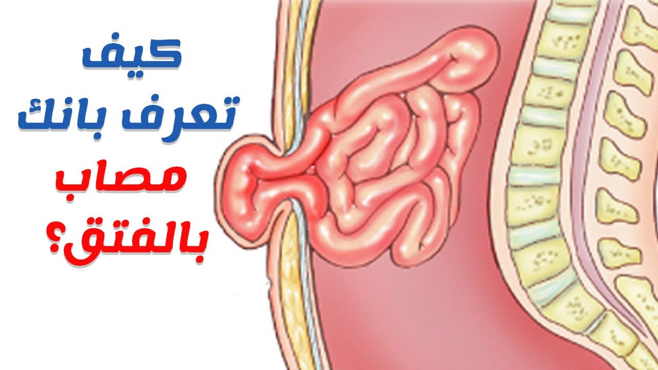 عملية الفتاق السري