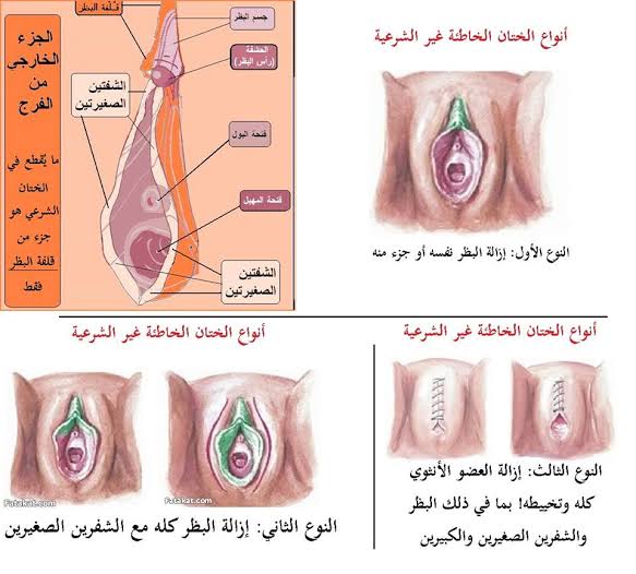 تضييق فتحة المهبل للبنات - حل مشكله توسيع المهبل 10118 1