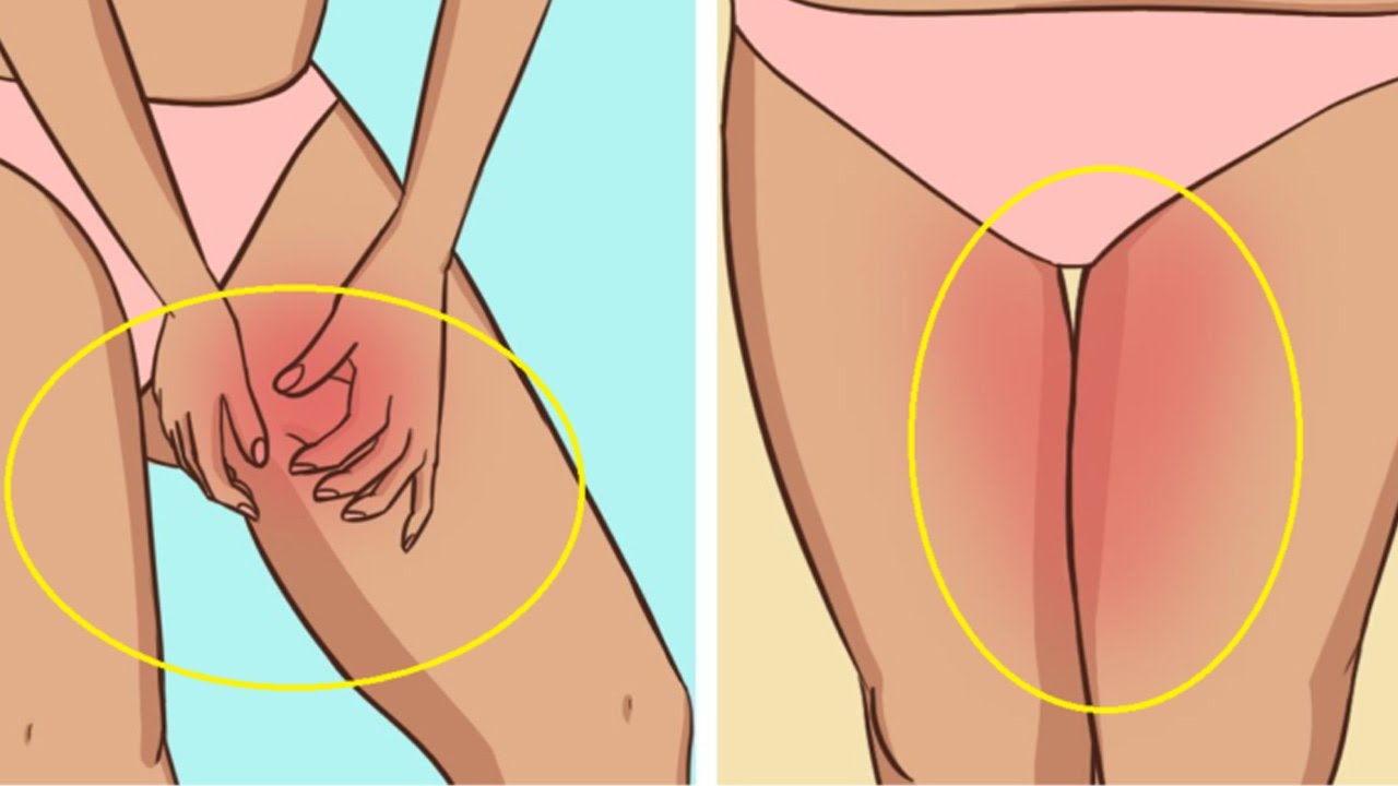حبوب بين الفخذين , افضل طرق علاج حبوب الفخدين