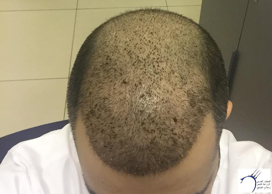 تجربة زراعة الشعر في تركيا بالصور , بعض صور لتجارب زراعه الشعر في تركيا