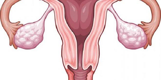 علاج تكيسات المبايض بالقران - تعاني من تكيسات المبايض اليكي العلاج بالقران 5026 3