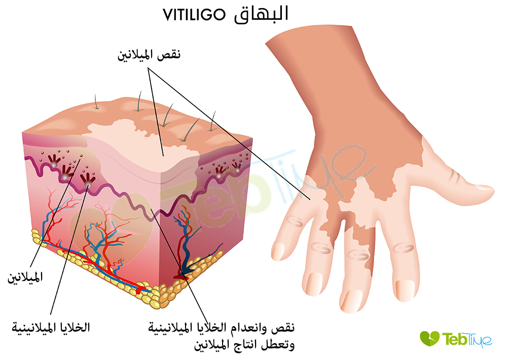 مرض البهاق بالصور - صور تظهر لنا مرض البهاق 5010 4