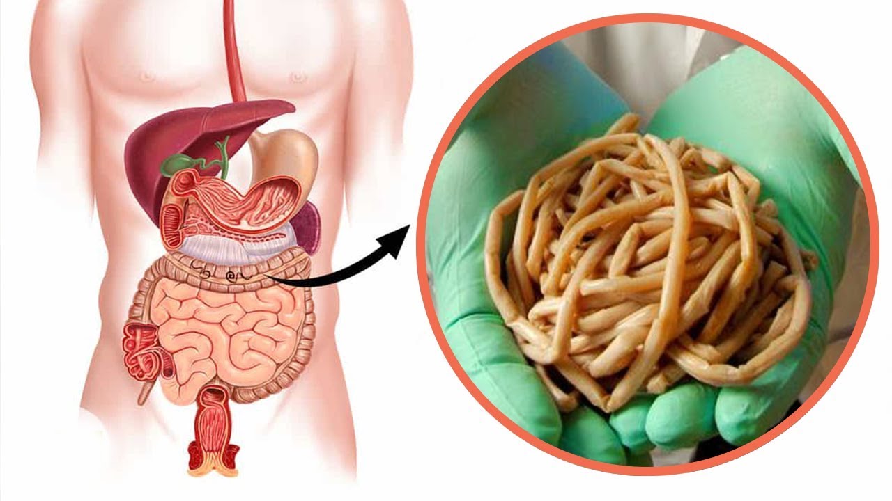 اسباب ديدان البطن , ما هي اسباب الاصابة بالديدان