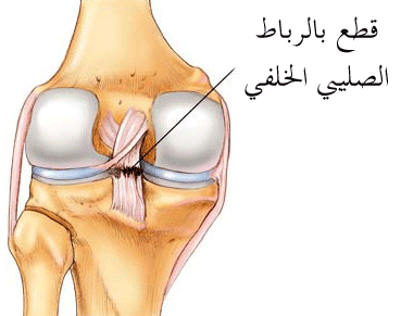 ماهي اضرار قطع الرباط الصليبي